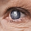 Что такое катаракта: признаки и причины